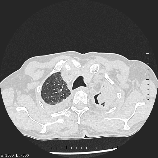 Aspergilloma (Radiopaedia 75184-86270 Axial lung window 8).jpg