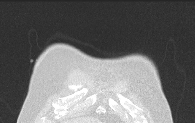 Aspirated tooth (Radiopaedia 28584-28844 Axial lung window 18).jpg