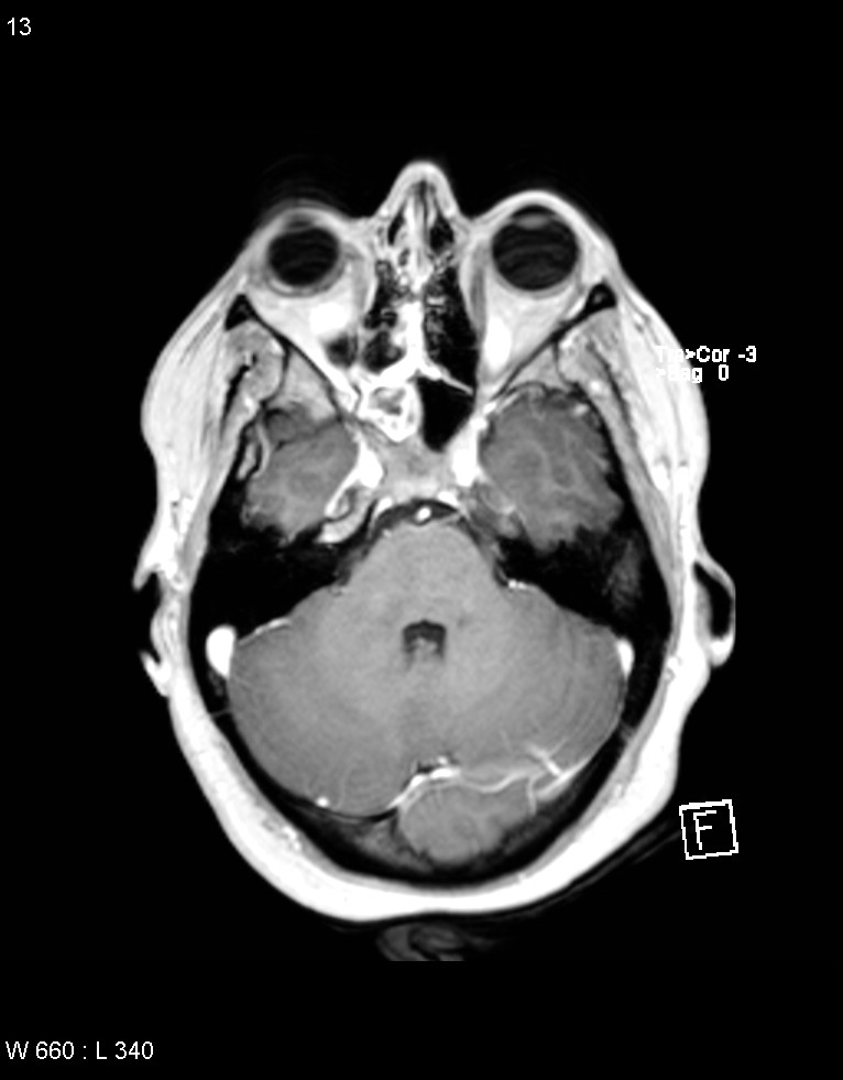 Astroblastoma (Radiopaedia 39792-42218 Axial T1 C+ 12).jpg