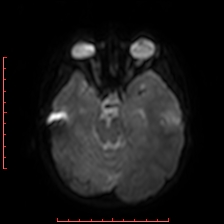 Astroblastoma (Radiopaedia 74287-85162 Axial DWI 31).jpg