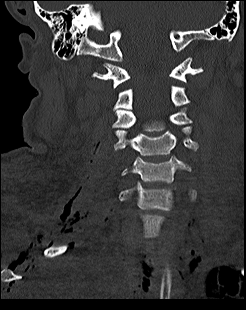 Atlanto-occipital dissociation - Traynelis type 1 (Radiopaedia 87570-103948 Coronal bone window 32).jpg