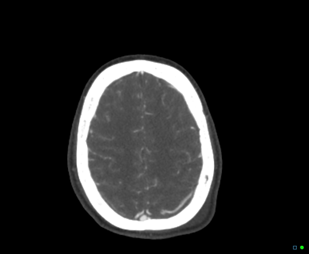 Atlanto-occipital dissociation - Traynelis type 1 (Radiopaedia 87570-103949 A 88).jpg