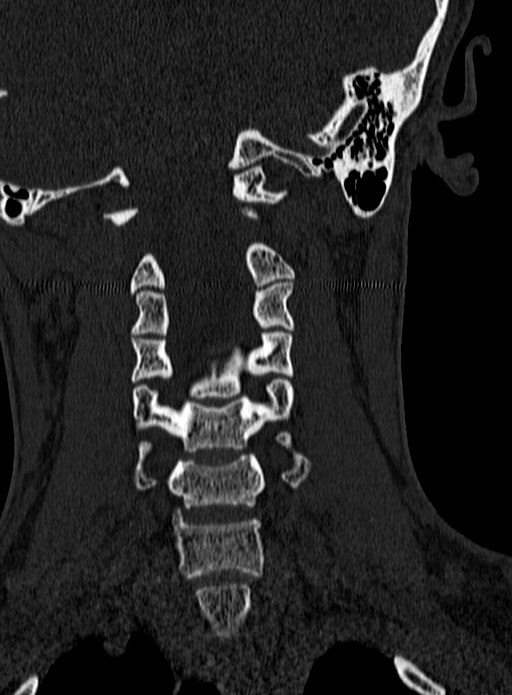 Atlantoaxial subluxation (Radiopaedia 44681-48450 Coronal bone window 70).jpg