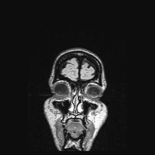 Atretic encephalocoele with inferior vermis hypoplasia (Radiopaedia 30443-31108 Coronal FLAIR 167).jpg