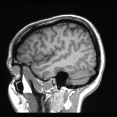 Atretic encephalocoele with inferior vermis hypoplasia (Radiopaedia 30443-31108 Sagittal T1 108).jpg