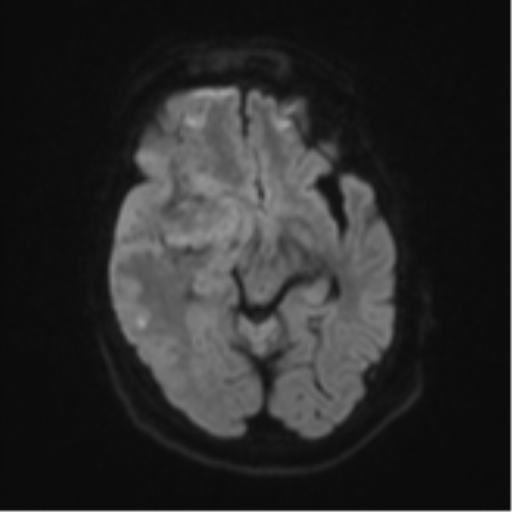 Atypical meningioma (WHO Grade II) (Radiopaedia 54742-60979 Axial DWI 40).png