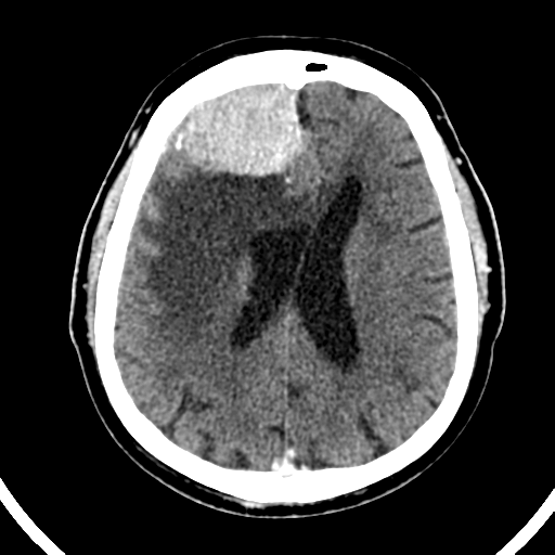 Atypical meningioma (WHO grade II) with brain invasion (Radiopaedia 57767-64728 Axial C+ 22).png