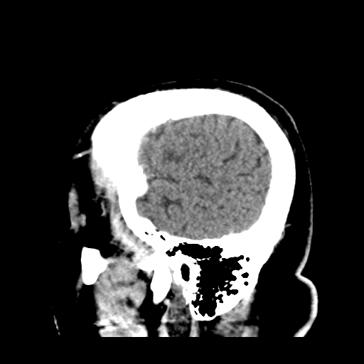 Atypical meningioma (WHO grade II) with brain invasion (Radiopaedia 57767-64728 Sagittal C+ 6).png