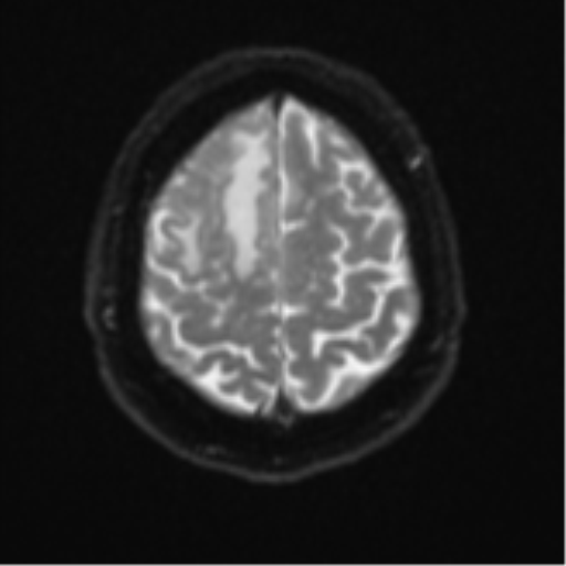 File:Atypical meningioma (WHO grade II) with brain invasion (Radiopaedia 57767-64729 Axial DWI 25).png