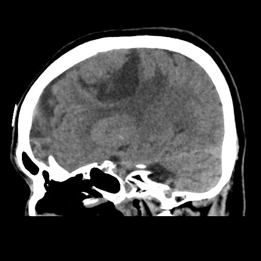 Atypical meningioma (WHO grade II) with osseous invasion (Radiopaedia 53654-59715 C 21).png