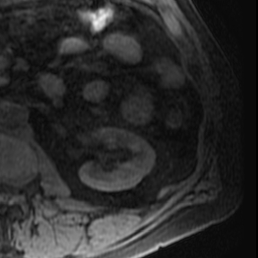 File:Atypical renal cyst on MRI (Radiopaedia 17349-17046 Axial T1 fat sat 20).jpg