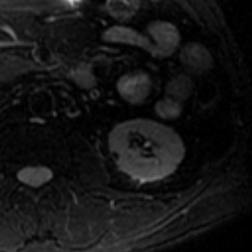 File:Atypical renal cyst on MRI (Radiopaedia 17349-17046 Axial T2 fat sat 16).jpg
