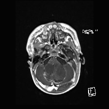 Atypical teratoid rhabdoid tumor (prenatal US and neonatal MRI) (Radiopaedia 59091-66388 Axial T1 C+ 16).jpg