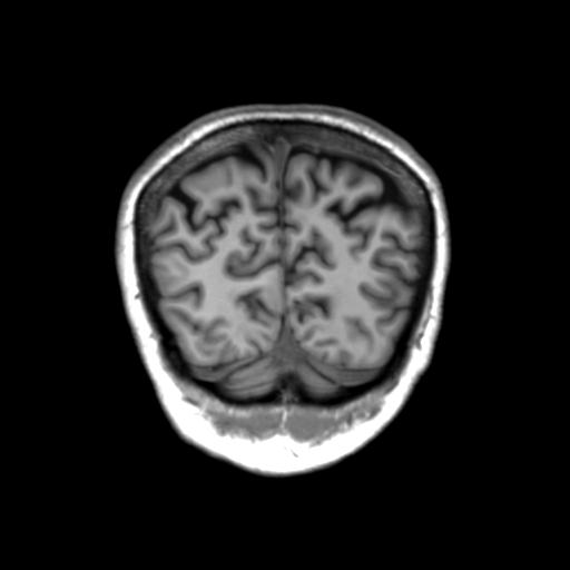 Autoimmune limbic encephalitis (Radiopaedia 30363-31005 Coronal T1 11).jpg