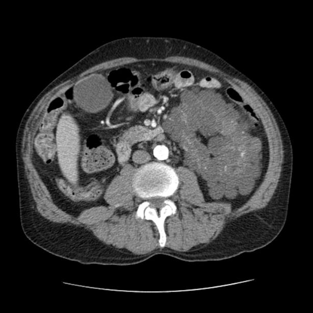 Autosomal dominant polycystic kidney disease (Radiopaedia 27851-28094 B 78).jpg