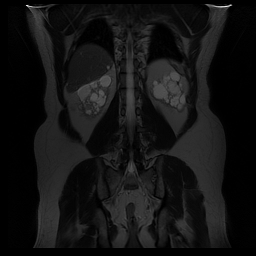 File:Autosomal dominant polycystic kidney disease (Radiopaedia 50259-55611 Coronal T2 28).jpg