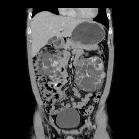 Autosomal dominant polycystic kidney disease (Radiopaedia 66349-75582 A 20).jpg