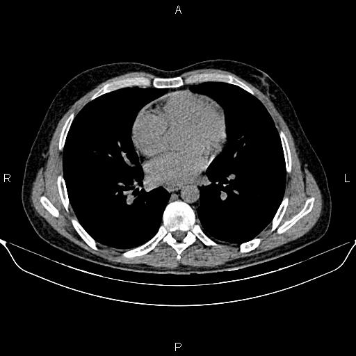 Autosomal dominant polycystic kidney disease (Radiopaedia 87830-104287 Axial non-contrast 2).jpg