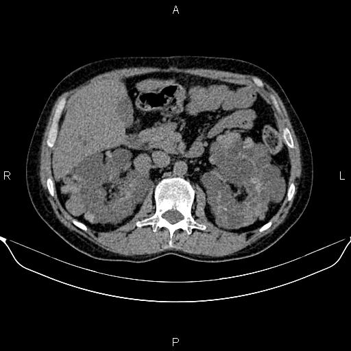 Autosomal dominant polycystic kidney disease (Radiopaedia 87830-104287 Axial non-contrast 22).jpg