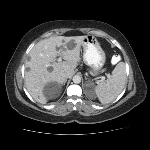File:Autosomal dominant polycystic kidney disease with hepatic involvement (Radiopaedia 32693-33662 B 16).jpg