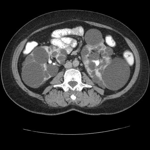 Autosomal dominant polycystic kidney disease with hepatic involvement (Radiopaedia 32693-33662 C 42).jpg