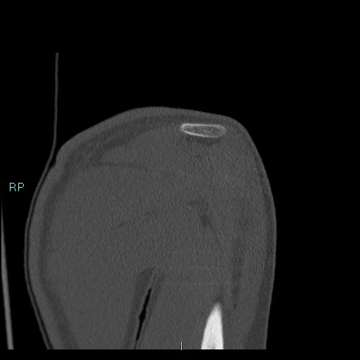 Avascular necrosis after fracture dislocations of the proximal humerus (Radiopaedia 88078-104655 Coronal bone window 49).jpg