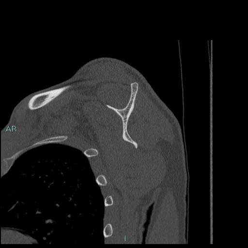 Avascular necrosis after fracture dislocations of the proximal humerus (Radiopaedia 88078-104655 Sagittal bone window 44).jpg