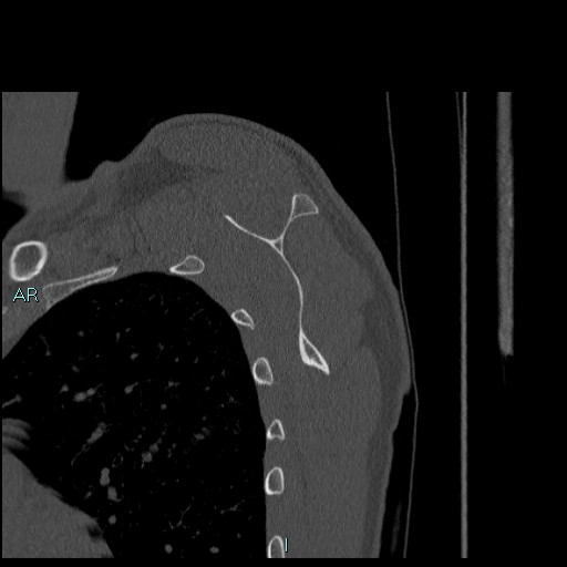 File:Avascular necrosis after fracture dislocations of the proximal humerus (Radiopaedia 88078-104655 Sagittal bone window 55).jpg