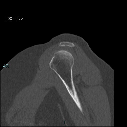 File:Avascular necrosis of the shoulder - Cruess stage I (Radiopaedia 77674-89887 Sagittal bone window 65).jpg