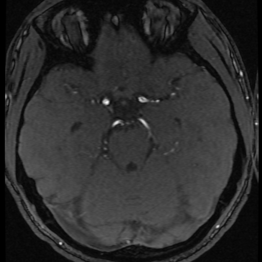 Azygos anterior cerebral artery (Radiopaedia 17059-16756 Axial MRA 46).jpg