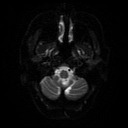 File:Balo concentric sclerosis (Radiopaedia 53875-59982 Axial DWI 27).jpg
