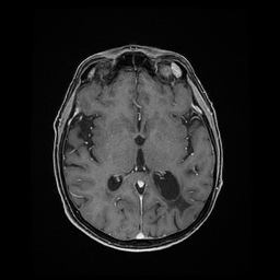 File:Balo concentric sclerosis (Radiopaedia 53875-59982 Axial LAVA C+ 137).jpg
