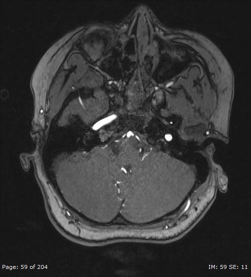 Balo concentric sclerosis (Radiopaedia 61637-69636 Axial MRA 59).jpg