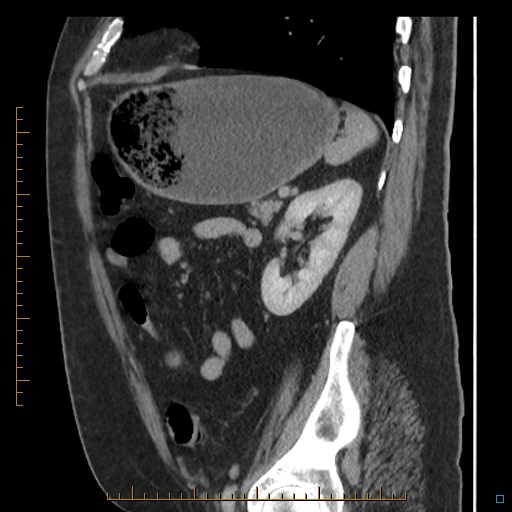 File:Bariatric balloon causing gastric outlet obstruction (Radiopaedia 54449-60672 C 24).jpg