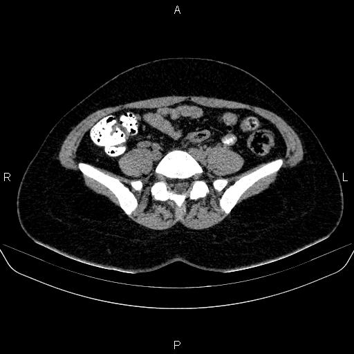 File:Bartholin gland cyst (Radiopaedia 62635-70930 Axial non-contrast 9).jpg