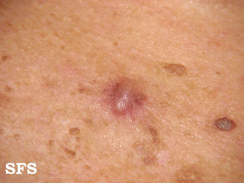 Basal Cell Carcinoma (Dermatology Atlas 21).jpg