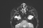 File:Basal cell carcinoma - nasal region (Radiopaedia 70292-80365 Axial DWI 10).jpg