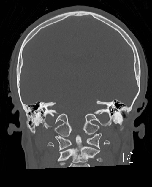 Base of skull fracture with bilateral Le Fort fractures (Radiopaedia 47094-51638 Coronal bone window 41).jpg