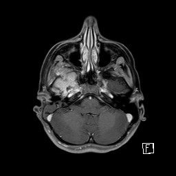 Base of skull rhabdomyosarcoma (Radiopaedia 32196-33142 T1 C+ fat sat 29).jpg
