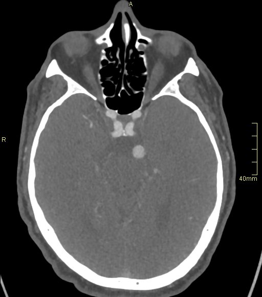 Basilar artery aneurysm (Radiopaedia 56261-62932 A 69).jpg