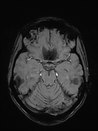 Basilar artery perforator aneurysm (Radiopaedia 82455-97733 Axial SWI 20).jpg