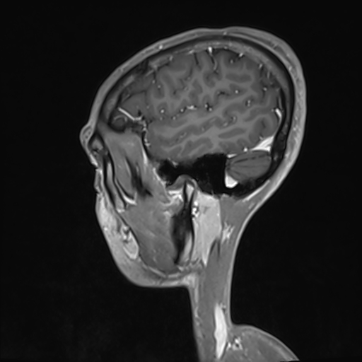 File:Basilar artery perforator aneurysm (Radiopaedia 82455-97733 G 123).jpg