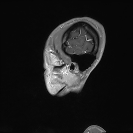 Basilar artery perforator aneurysm (Radiopaedia 82455-97733 G 135).jpg
