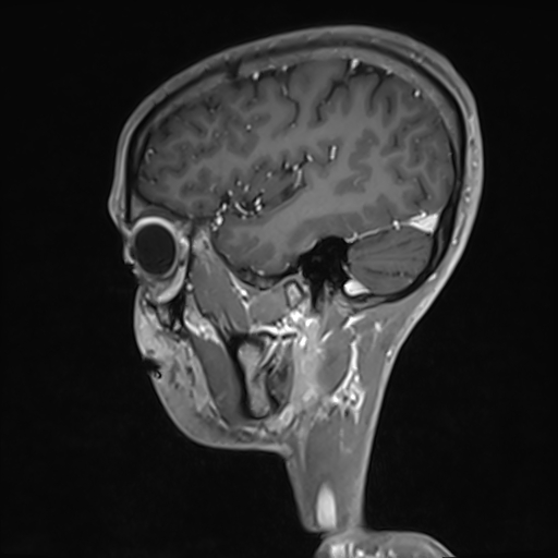 Basilar artery perforator aneurysm (Radiopaedia 82455-97733 G 36).jpg