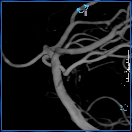 Basilar artery perforator aneurysm (Radiopaedia 82455-99524 3D Left VA 27).jpg