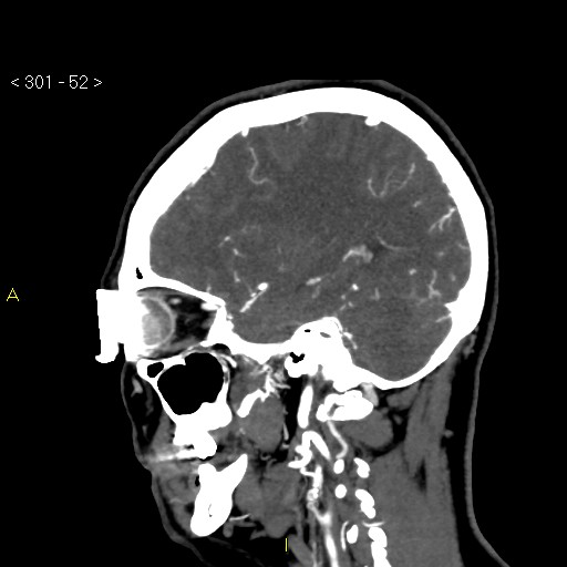 Basilar artery thrombosis (Radiopaedia 16260-15944 C 46).jpg