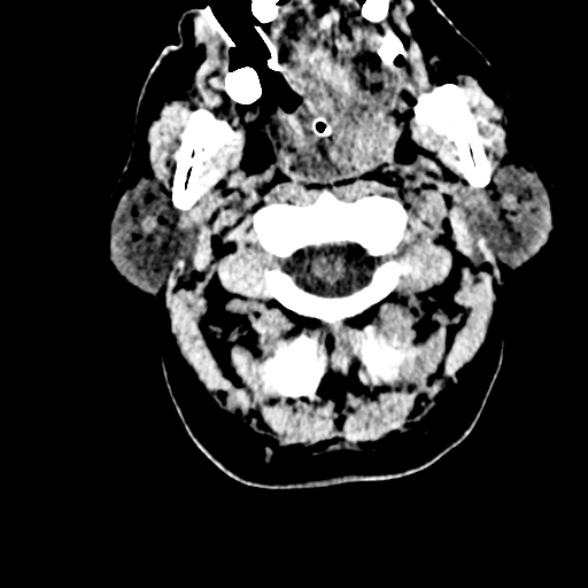 Basilar artery thrombosis (Radiopaedia 53351-59352 Axial non-contrast 10).jpg