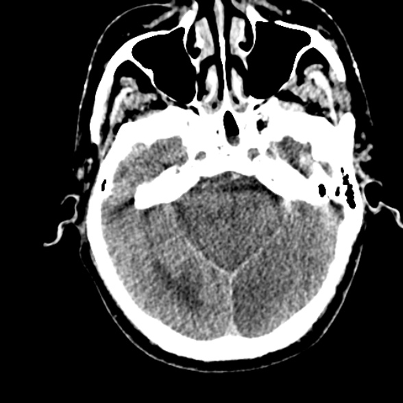 File:Basilar artery thrombosis (Radiopaedia 53351-59352 Axial non-contrast 41).jpg
