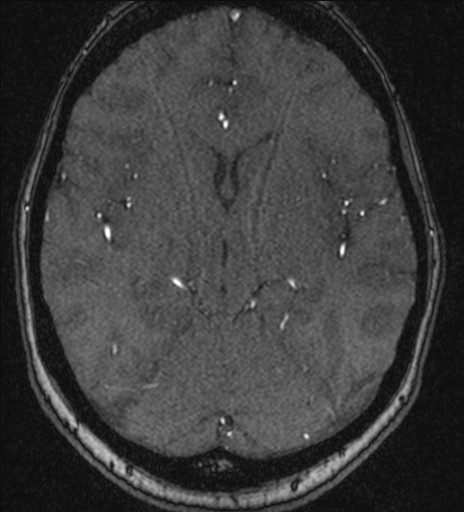 Basilar tip aneurysm (Radiopaedia 26504-26632 MRA 113).jpg