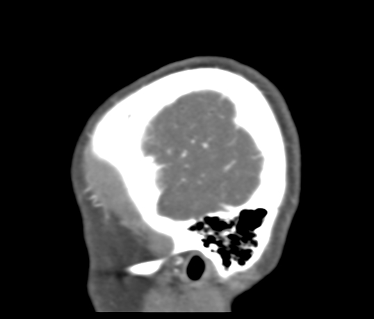 Basilar tip aneurysm with coiling (Radiopaedia 53912-60086 C 127).jpg